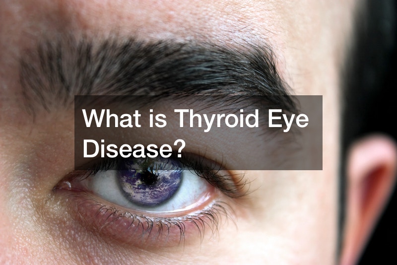 What Is Thyroid Eye Disease Bright Healthcare 7640